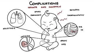 What is Pertussis and whooping cough  Bordetella pertussis symptoms pathophysiology and treatment [upl. by Bonni]