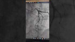 Myocardial bridging cardiologyangiography [upl. by Suolekcin]