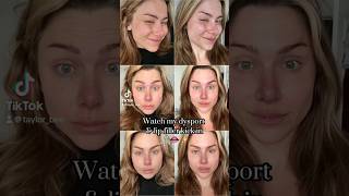 Watch my lip filler amp Dysport set in  daily progress [upl. by Standley]