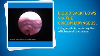 SDX FEES backflow during a FEES exam [upl. by Elacim]