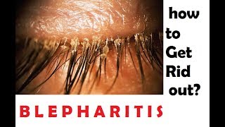 what is blepharitis How to get rid out of this hindi [upl. by Linehan319]