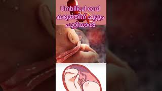 Cord around neck malayalam pregnancycomplication baby deliverylife umbilical umbilicalcord [upl. by Shoemaker]