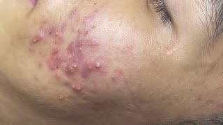 ACNE TREATMENT VU QUYNH MI  Perennial Blackheads On Boy Face 2024FULL [upl. by Iarahs]