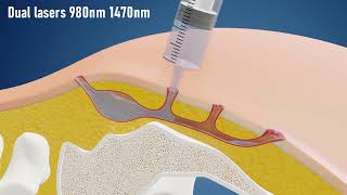 Sinus Laser Ablation Of Pilonidal Cyst SILAC  IBI Healthcare Institute [upl. by Nednil]