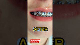 Before amp After Brace Fitting Appointment Spaced Teeth shorts braces [upl. by Eimaraj282]