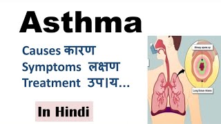 Asthma  Bronchial asthma  Causes Symptoms Diagnosis Treatment Prevention  Asthma in Hindi [upl. by Janith838]