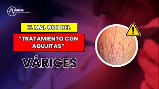 🔴 El mal uso del “Tratamiento con Agujitas”  Várices ❗👨‍⚕️ [upl. by Ellenet]