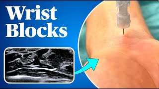 Wrist Blocks Landmark AND ultrasound guided approaches [upl. by Susana]