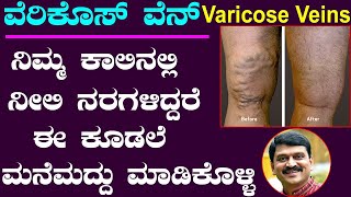 Varicose Veins Treatment in Kannada  Ayurveda tips in Kannada  Media Master  ಕಾಲಿನಲ್ಲಿ ನೀಲಿ ನರಗಳು [upl. by Flinn]