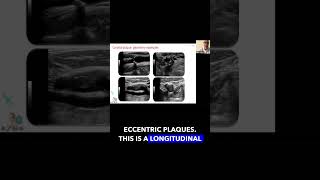 Carotid Plaque Geometry foryou science education vascularultrasound [upl. by Tiana]