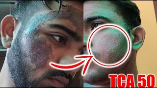 How to Fix Hyperpigmentation 100 end to end in Hindi  fix hyperpigmentation in 2024 [upl. by Nimajnab]