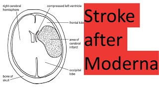 Stroke and death after Moderna [upl. by Jeremiah]