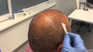 EASY TCA® PAIN CONTROL at Dameto Clinics Scalp preparation before hair restoration [upl. by Reiss]