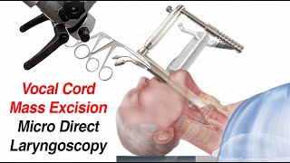 Vocal Cord Surgery Mass Excision  Micro Direct Laryngoscopy [upl. by Sirret]