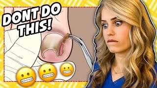 Doctor reacts Ingrown nail gone wrong [upl. by Innattirb]