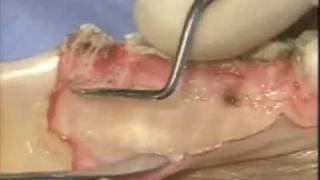 Introductory Periodontal Surgical Techniques The Apically Positioned Flap and Crown Lengthening [upl. by Egiarc]