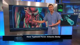 How Typhoid Fever Affects the Body  The Doctors [upl. by Trow]