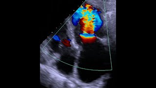 Mitral stenosis Overview and common causes [upl. by Nari]