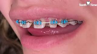 Braces On Checkups  Infinity ties  lace ties  power chains  Tooth Time Family Dentistry NBTX [upl. by Ainoloppa231]