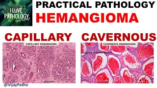 HEMANGIOMA capillary amp Cavernous Clinical features amp Morphology [upl. by Dreher]