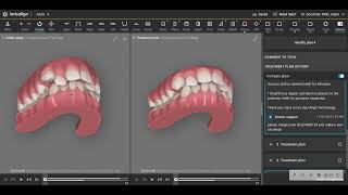 Carriere Motion Appliance Prior to Invisalign [upl. by Martijn]