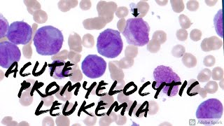 Acute Promyelocytic Leukemia APL microgranular vs classic cottage loaf cells Hematology [upl. by Toulon]