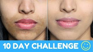 How To Get Even Skin Tone Naturally Powerful Home Remedy Hyper Pigmentation [upl. by Ahsika408]