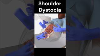 Shoulder Dystocia [upl. by Idurt]