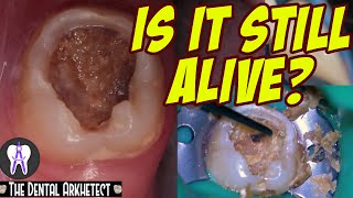 AMAZING Save of A Tooth w A Very BIG and DEEP Cavity 4k C28 [upl. by Sidnala637]