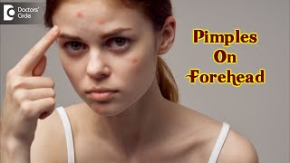 Pimples On Your Forehead Causes amp how to get rid of it  Dr Urmila Nischal  DoctorsCircle [upl. by Bocoj]