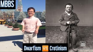 Dwarfism 🆚 Cretinism Differences MBBS NEETPG [upl. by Lauri]