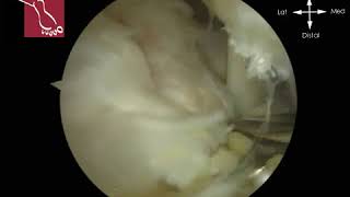 Endoscopic Removal of Os Trigonum [upl. by Yelserp]