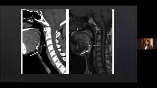 Radiological anatomy of Larynx and Hypopharynx Dr Kajari Bhattacharya [upl. by Eiramaliehs634]