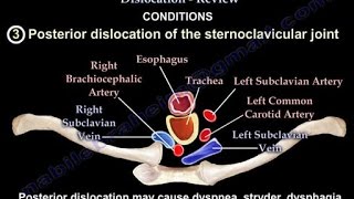 Sternoclavicular Joint Dislocation Review  Everything You Need To Know  Dr Nabil Ebraheim [upl. by Gaiser208]