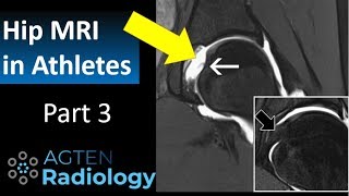 MRI of hip injuries in Athletes  Part 3 [upl. by Ronnholm188]