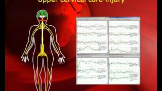 quotPatient Transparentquot Intraoperative Neurophysiological Monitoring in MISS [upl. by Alf]