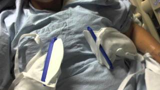 BREAST REDUCTION STEP 2 surgery and recovery [upl. by Ahsitra]