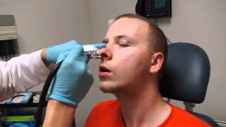 Septoplasty Nasal Splint Packing removal and nose cleaning [upl. by Hindu]