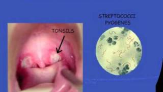 Streptococcal pharyngitis [upl. by Whitebook237]