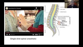 University of Kentucky Anesthesiology Neuraxial Anesthesia Topics  Dr Gist [upl. by Entsirhc109]