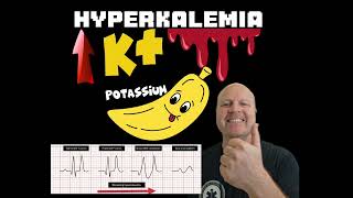 Why Hyperkalemia causes a widened QRS complex on the ECG  Explained [upl. by Ahsiral]