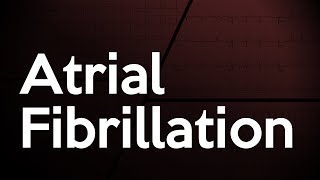 Atrial Fibrillation ECG [upl. by Shurlocke]