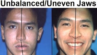 Orthodontic Treatment of Asymmetrical Unbalanced Disproportionate or Unequal Jaw by Dr Mike Mew [upl. by Maidel]