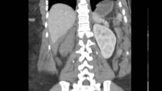 CT Abdomen Trauma w Hepatic laceration Discussed by Radiologist [upl. by Anirres]