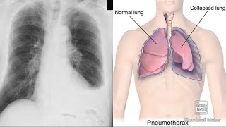 Pleurisy Pleural effusion Pneumothorax Hydropneumothorax Empyema Hemothorax clinicalAnatomy [upl. by Noemis]