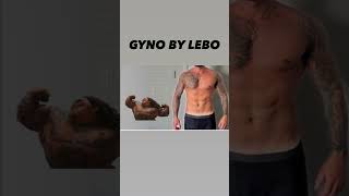 GYNECOMASTIA SURGERY AND BEYOND [upl. by Noeht]