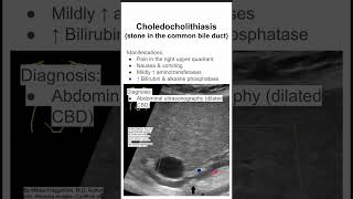 Choledocholithiasis stone in the common bile duct [upl. by Mylander]