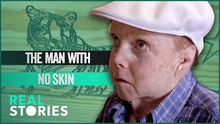 Man With Fatal Skin Condition Plans His Own Funeral  BAFTAWinning Documentary  Real Stories [upl. by Galang]