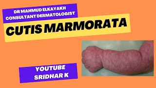 Cutis marmorata or Livedo reticularisa dermatologists perspective newbornrash Cutismarmorata [upl. by Aleyak327]