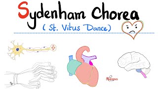 Sydenham Chorea St Vitus Dance  Rheumatic Fever  Neurology amp Cardiology [upl. by Lerner]